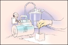 tube tracheostomy suctioning stoma saline suction trach normal caring discharge instructions drawing plugged becomes