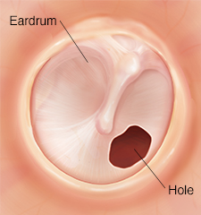 Ruptured Eardrum  Saint Luke's Health System