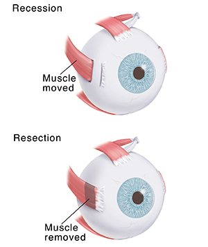 Strabismus Surgery | Saint Luke's Health System