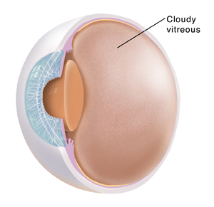 Diabetic Retinopathy Having A Vitrectomy Saint Luke S Health System