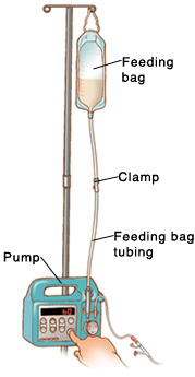 Feeding bag hanging from pole on pump. Feeding bag tubing goes from bag to pump. Clamp is in middle of tubing. Finger is pressing the On button.
