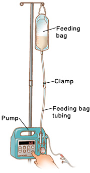 Your Child's Nasogastric Tube: Pump Feeding