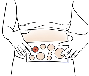 Measuring – How to size your stoma 