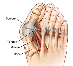 Osteotomy And Ligament Or Tendon Repair Bunion Surgery Saint Luke S Health System