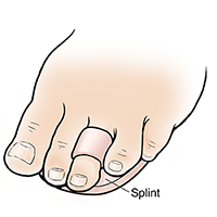 Treating Mallet, Hammer, and Claw Toes | Saint Luke's Health System