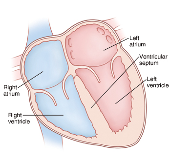 When Your Child Has a Ventricular Septal Defect (VSD) | Saint Luke's ...