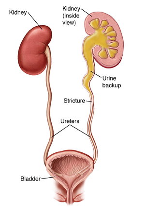 Ureteral Stricture Surgery Ureteroplasty Saint Luke S Health System