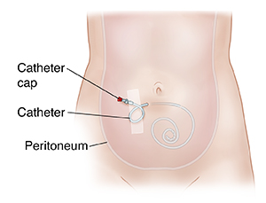 Maintaining Your Peritoneal Dialysis Catheter Azura Vascular Care