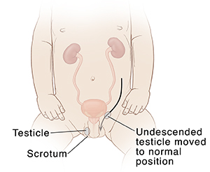 Photograph of the groin-the arrow indicating the position of the