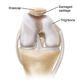 Knee cap problem new arrivals