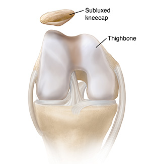 kneecap not aligned