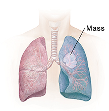 Front view of chest showing lungs. Shaded area shows pneumonectomy.