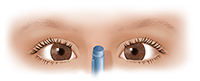 Front view of child's eyes focusing on object normally.