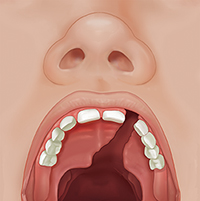 Front view of child's open mouth showing complete cleft palate.