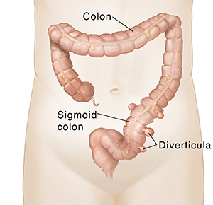 Understanding Diverticulosis And Diverticulitis Saint Luke S Health   Front View Of Colon With Diverticula Pouches In Lower Part 362677