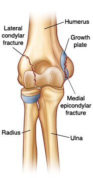 Front view of elbow joint showing radius, ulna, humerus, and growth plate on bottom and side of humerus. Lateral condylar fracture is on outside lower humerus. Medial epicondylar fracture is on inside lower humerus at growth plate.