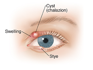 blepharitis define