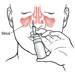 nasal spray headache