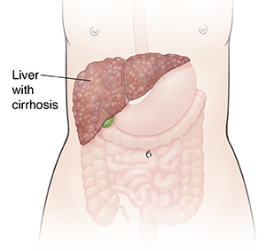Front view of female outline showing digestive system and liver with cirrhosis.