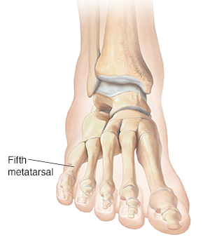 Understanding Fifth Metatarsal Fracture Saint Luke s Health System