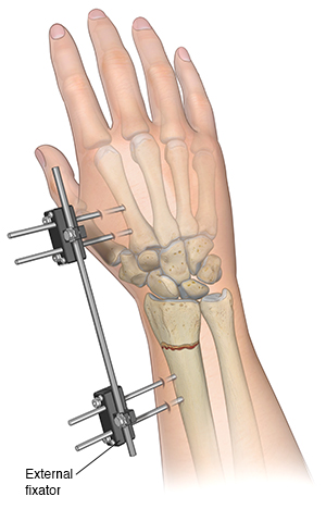 Treating Wrist Fractures | Saint Luke's Health System