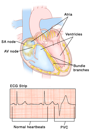 Premature Ventricular Contractions Saint Luke S Health System