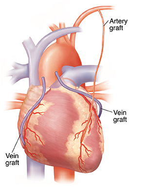 On-pump vs Off-pump CABG