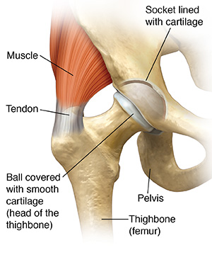 Understanding Hip Replacement