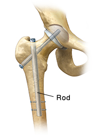 fracture hip rod surgery types femur metal joint nail bone screw used shaft upper along if