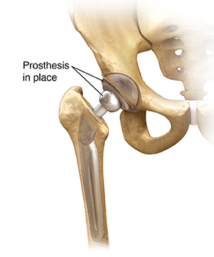 Total Hip Replacement FAQ - Scottsdale Joint Center