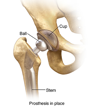 https://api.kramesstaywell.com/Content/6066ca30-310a-4170-b001-a4ab013d61fd/ucr-images-v1/Images/front-view-of-hip-joint-with-total-prosthesis-in-place-346521