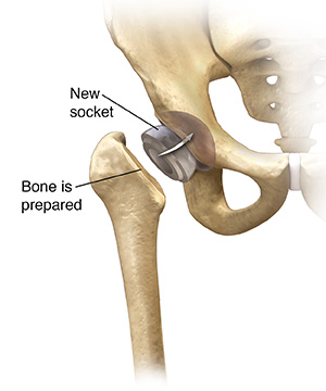 Hip Replacement Surgery  Saint Luke's Health System