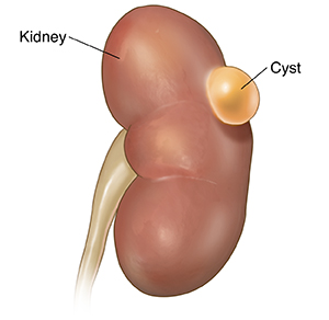 Simple Kidney Cysts Saint Luke S Health System   Front View Of Kidney With Simple Cyst 381454