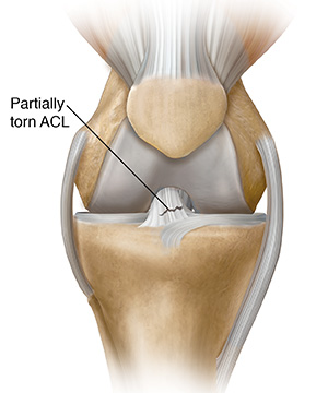 Front view of knee joint showing partial tear in anterior cruciate ligament.