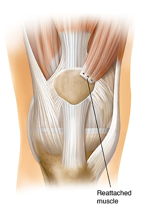 Knee cap clearance operation