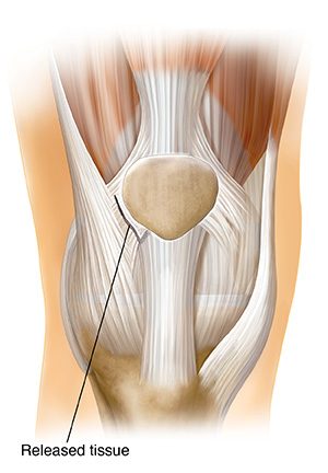 kneecap surgery