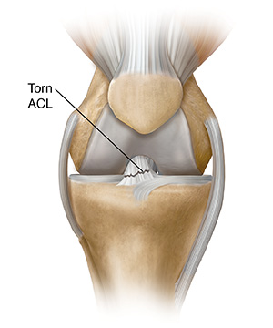 Anterior Cruciate Ligament (ACL) Tear and Injury in A Knee