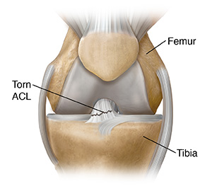 Anterior Cruciate Ligament Tear (ACL Tear) - Sarasota, FL: Schofield, Hand  and Bright Orthopaedics