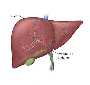 Chemoembolization for Liver Cancer: The Procedure | Saint Luke's Health ...