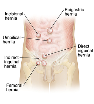 What Is A Hernia Saint Luke S Health System