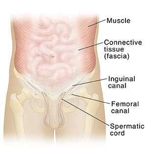 Photograph of the groin-the arrow indicating the position of the left