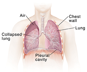 Pneumothorax (Collapsed Lung) | Saint Luke's Health System