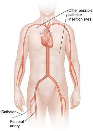 Front view of male figure showing cardiovascular system with catheter inserted in femoral artery to carotid artery. Other possible catheter insertion sites shown.