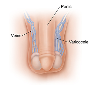 Varicocele -Symptoms, Causes and Treatment, Varicocele Natural Treatment