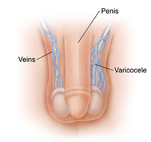 Having Varicocele Embolization