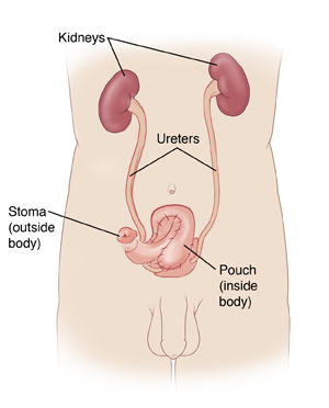 Total Cystectomy With Continent Urinary Diversion In Men - 