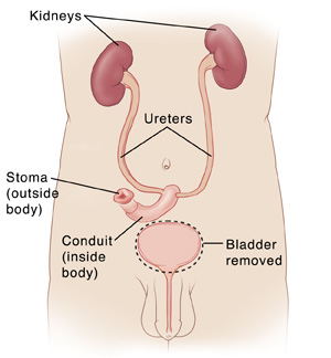Total Cystectomy with Incontinent Urinary Diversion in Men ...
