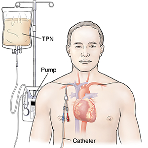 IV Care: Total Parenteral Nutrition (TPN) Therapy | Saint Luke's Health  System