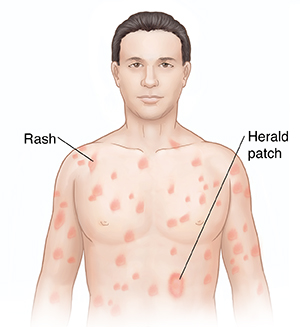 Understanding Pityriasis Rosea Saint Luke S Health System