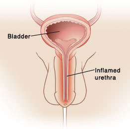 Inflamed Urethra Photos and Images & Pictures